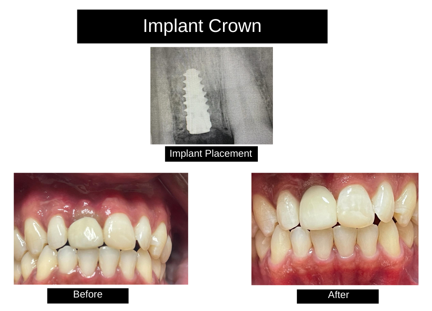 Dental Implants Nassau, Bahamas The Bahamas center for Gum Diseases